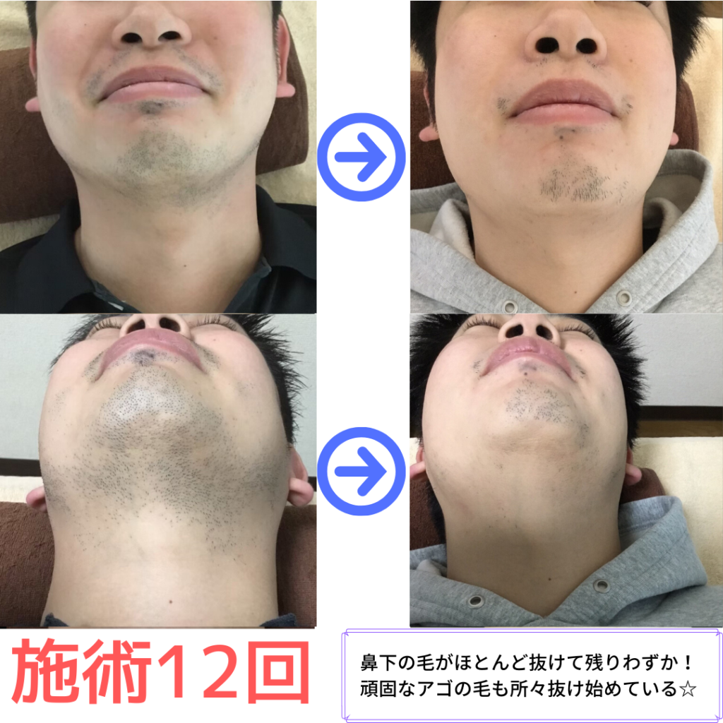 ひげ脱毛　１２回ビフォーアフター